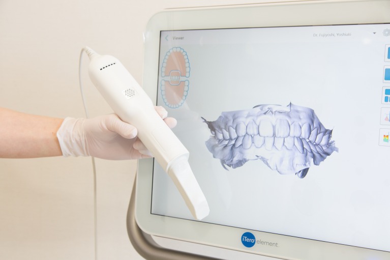 1回の印象採得ですべてのマウスピースが作製できる