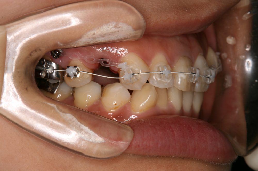 スクリュー アンカー 歯科矯正用アンカースクリューをご存知ですか？