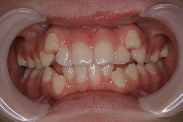 ガタガタ歯 叢生 八重歯を治したい 神戸市垂水区のふじよし矯正歯科クリニック