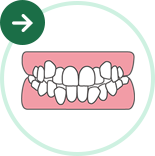 ガタガタ歯・八重歯の矯正