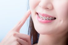 ブラケットが外れる原因とは？