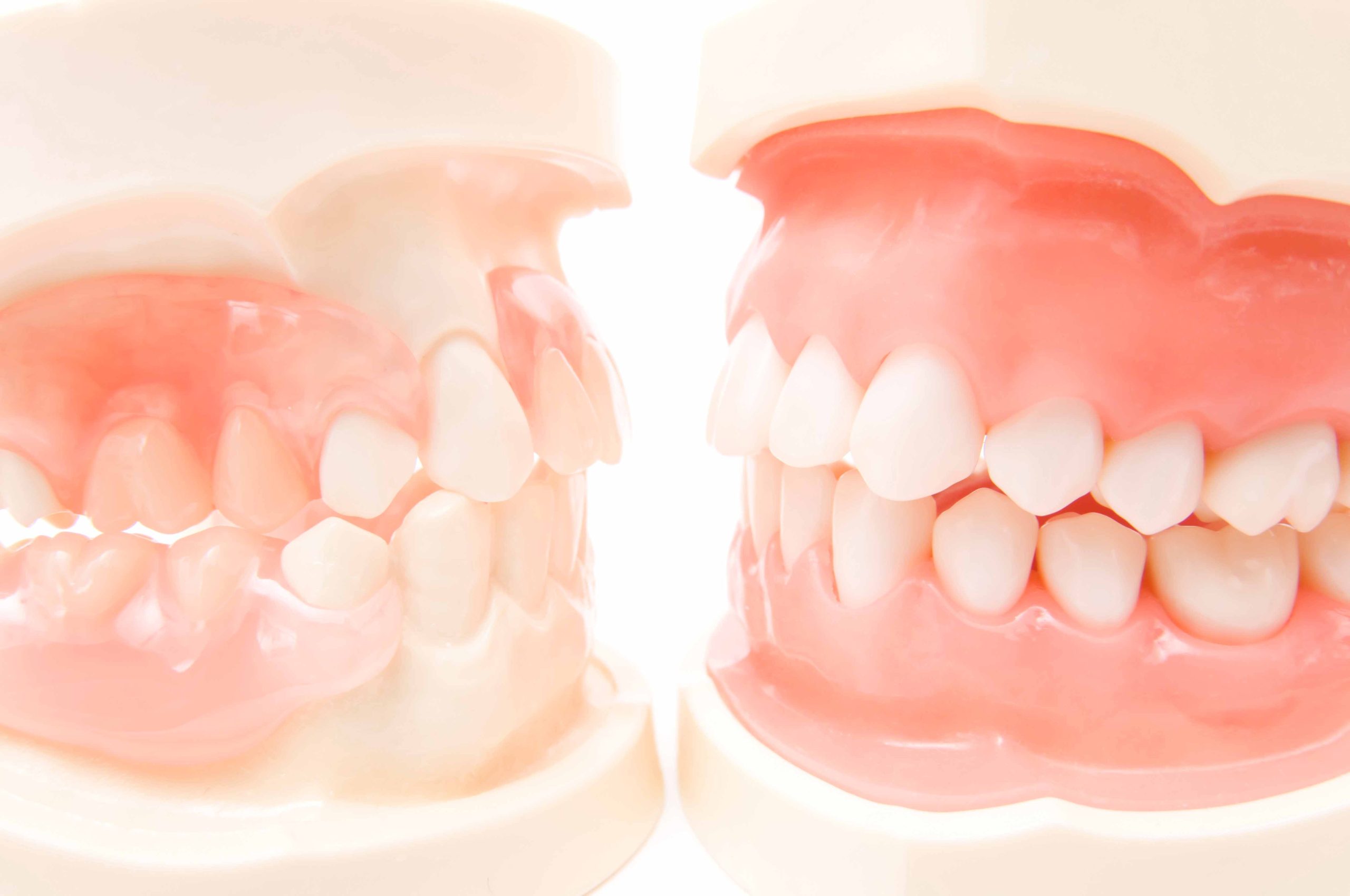 2つの歯の模型